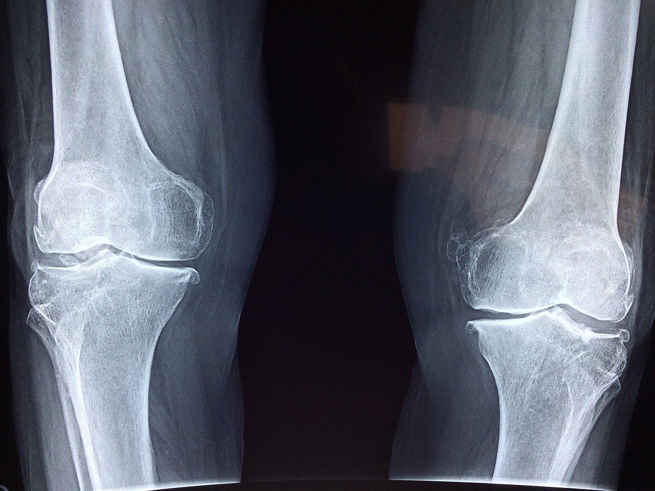 knee, x-ray, medical-2253047.jpg